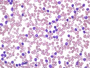 Chronic Lymphocytic Leukemia - 1.