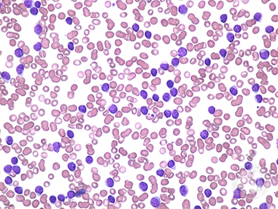 Chronic Lymphocytic Leukemia - 1.