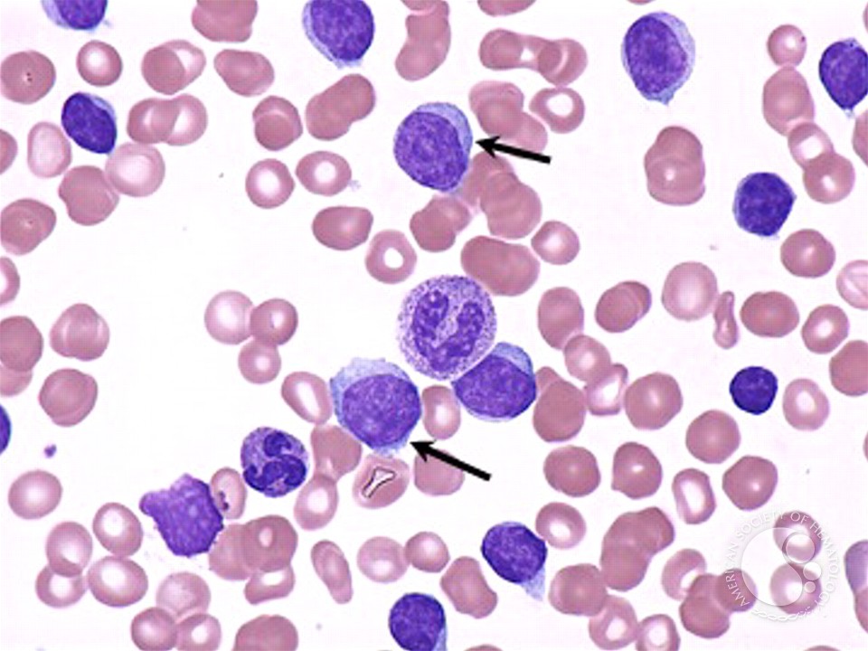 Chronic Lymphocytic Leukemia - 2.