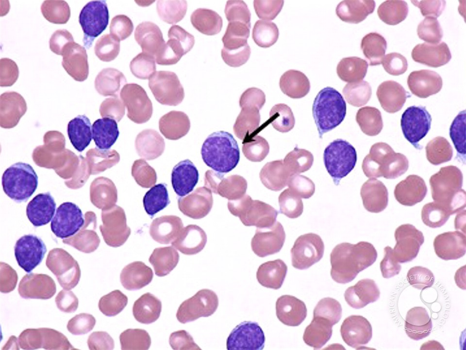 Chronic Lymphocytic Leukemia - 3.