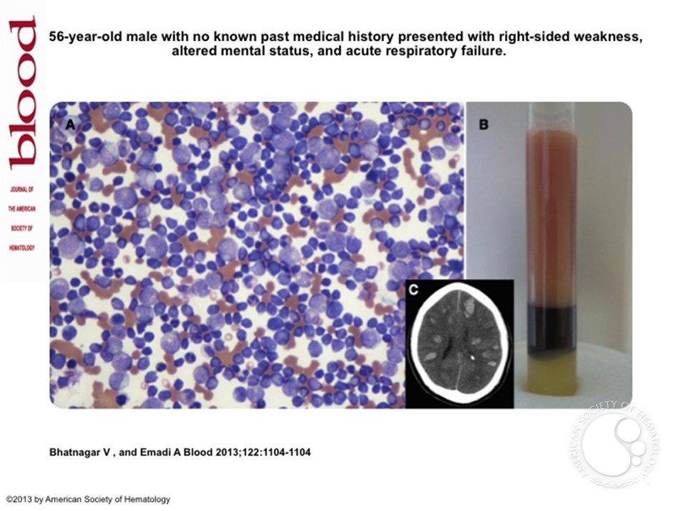 Philadelphia chromosome positive acute B-lymphoblastic leukemia with extreme leukocytosis