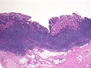Gastric MALT Lymphoma - 2.