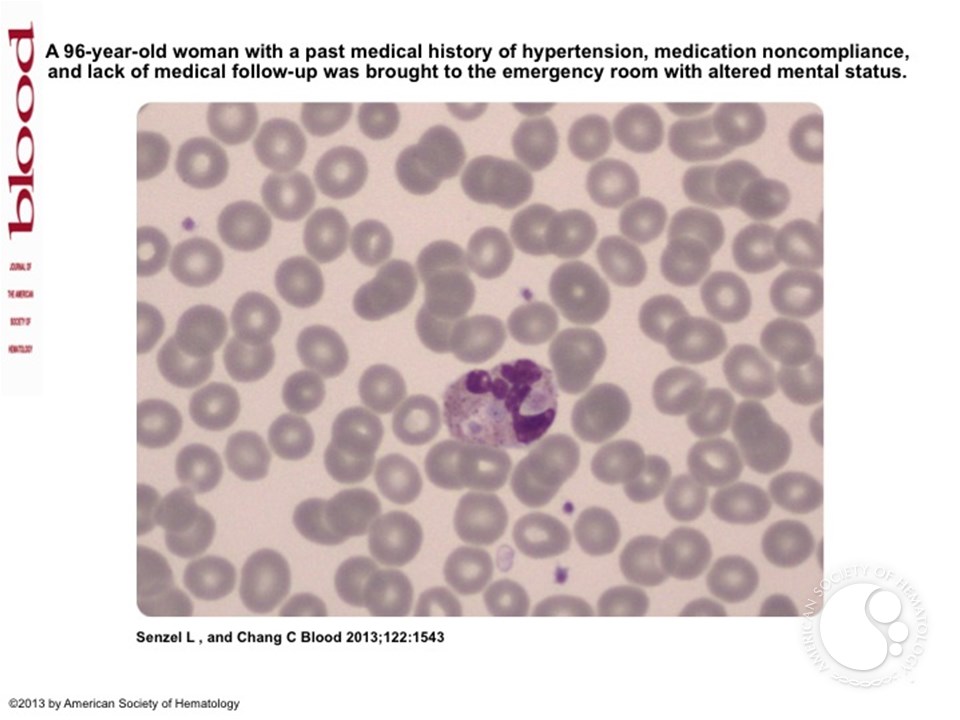 Platelet phagocytosis by neutrophils