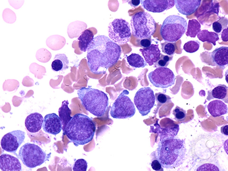 Acute Myeloid Leukemia with Multilineage Dysplasia - 1.