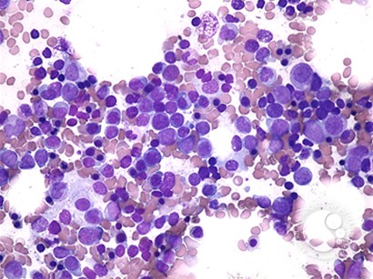 Acute Myeloid Leukemia with Multilineage Dysplasia - 2.