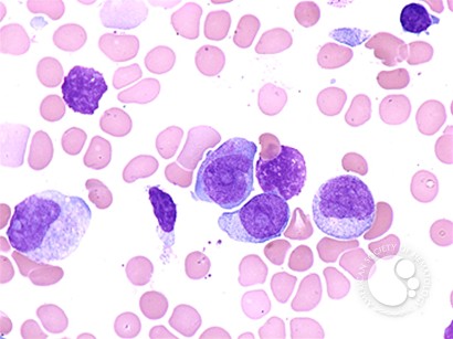 Acute Myeloid Leukemia with Multilineage Dysplasia - 4.