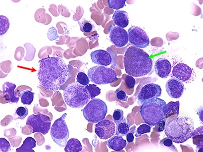 Acute Myeloid Leukemia with Multilineage Dysplasia - 5.