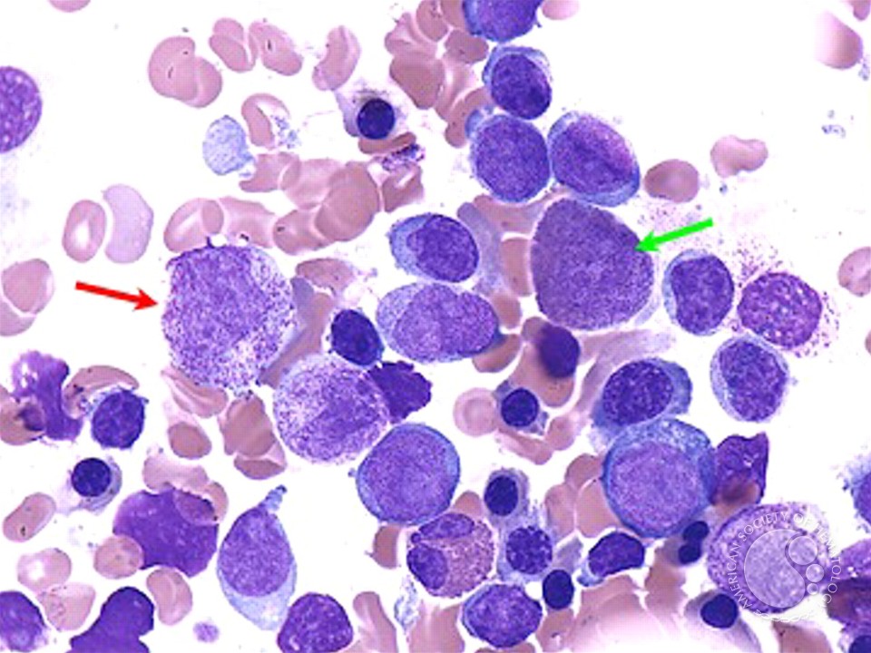Acute Myeloid Leukemia with Multilineage Dysplasia - 5.