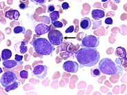 Acute Myeloid Leukemia with Multilineage Dysplasia - 7.