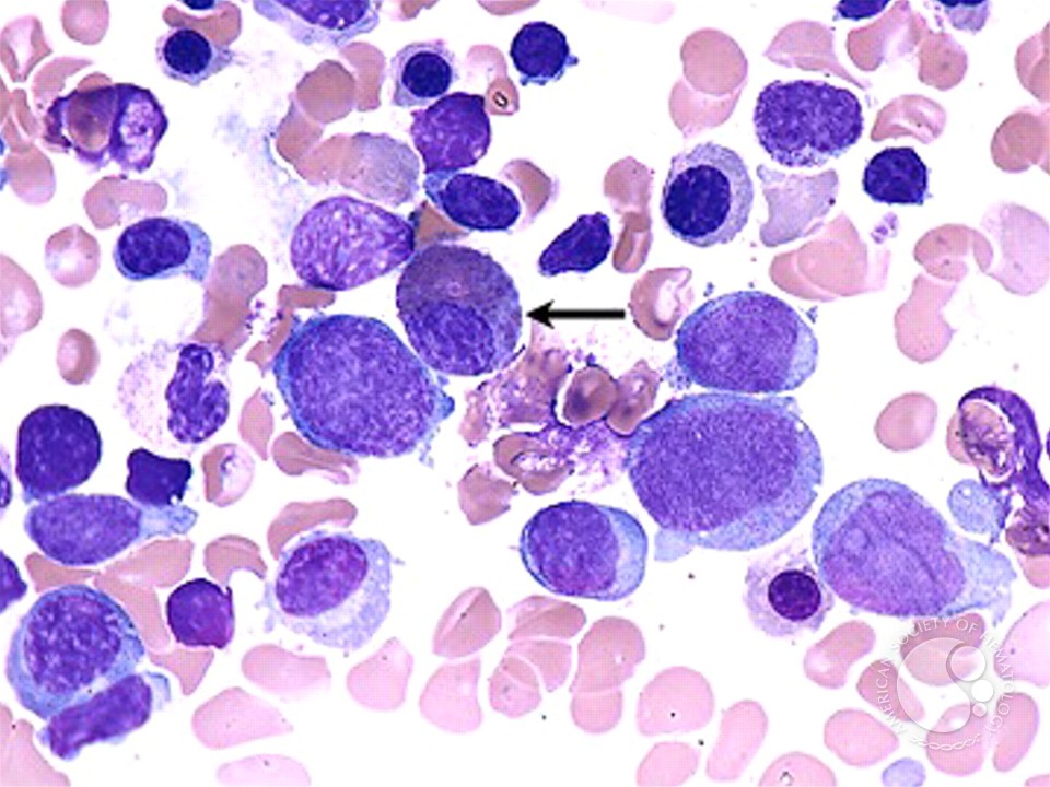 Acute Myeloid Leukemia with Multilineage Dysplasia - 7.