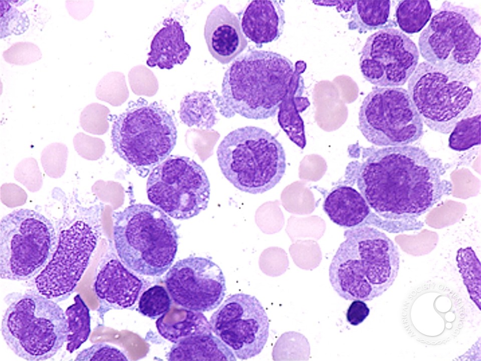 Chronic Myelomonocytic Leukemia - 4.