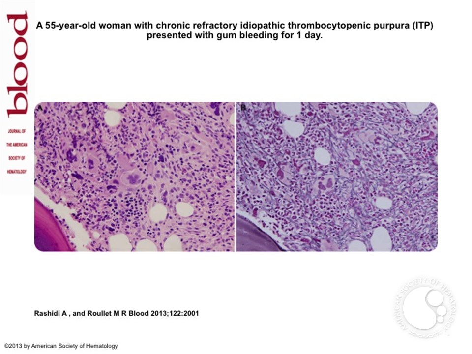 Romiplostim-induced myelofibrosis
