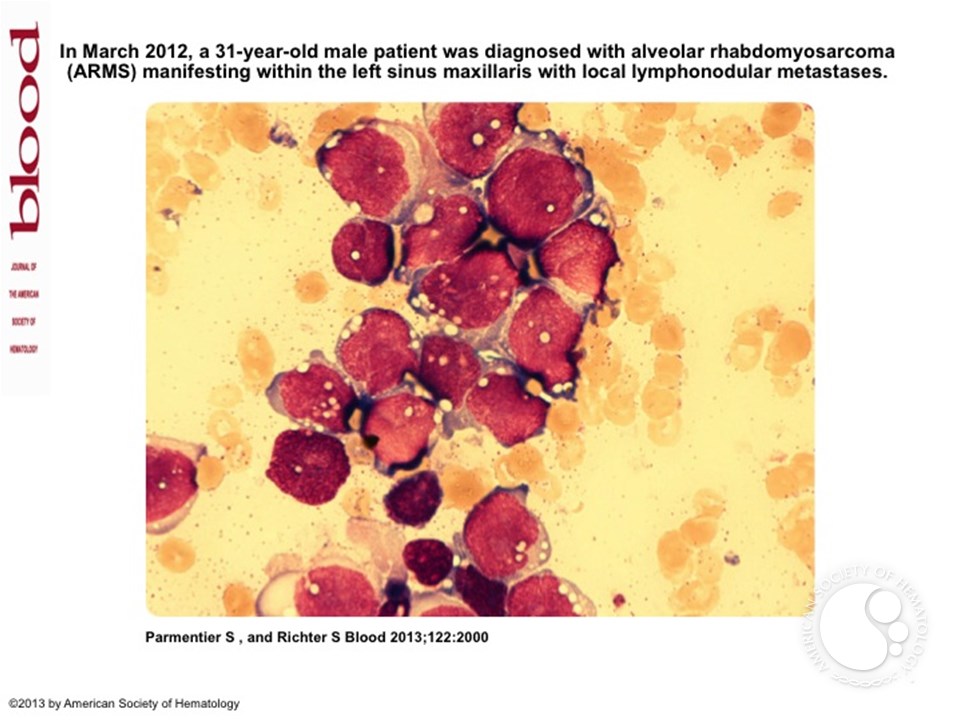 Bone marrow metastases by alveolar rhabdomyosarcoma in a 31-year-old patient