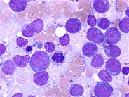 Acute Myeloid Leukemia without Maturation - 2.