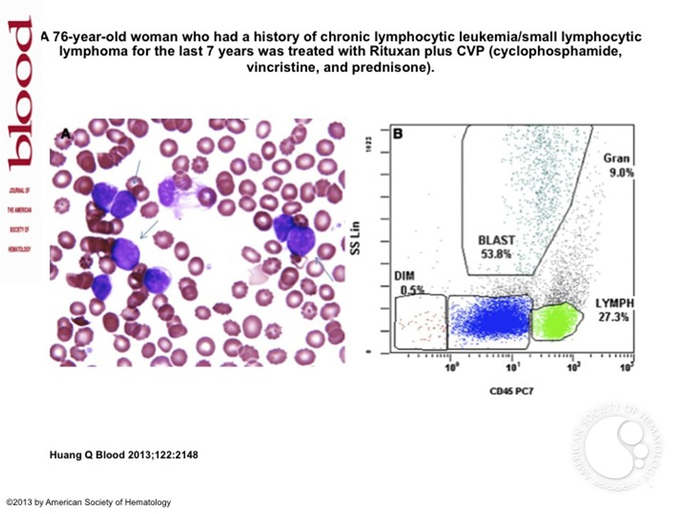 Co-circulating precursor B acute lymphoblastic leukemia and chronic lymphocytic leukemia