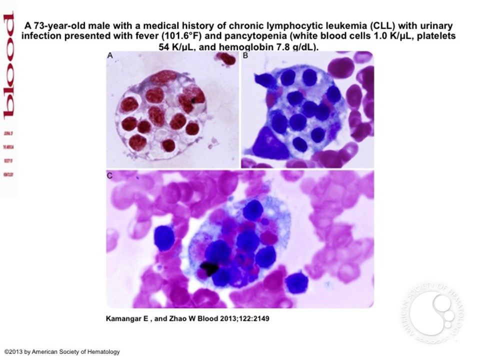 Hemophagocytosis in a patient with persistent chronic lymphocytic leukemia