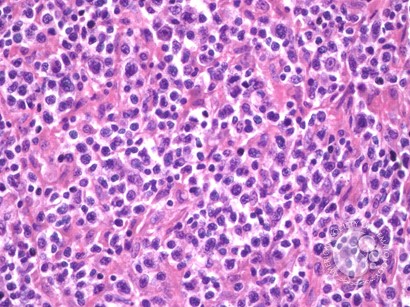 Peripheral T Cell Lymphoma, NOS - 1.