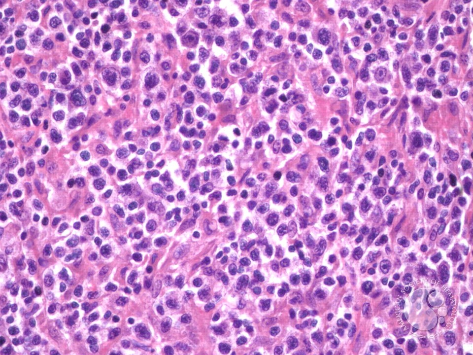Peripheral T Cell Lymphoma, NOS - 1.