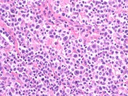 Peripheral T Cell Lymphoma, NOS - 2.