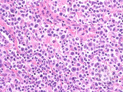 Peripheral T Cell Lymphoma, NOS - 2.
