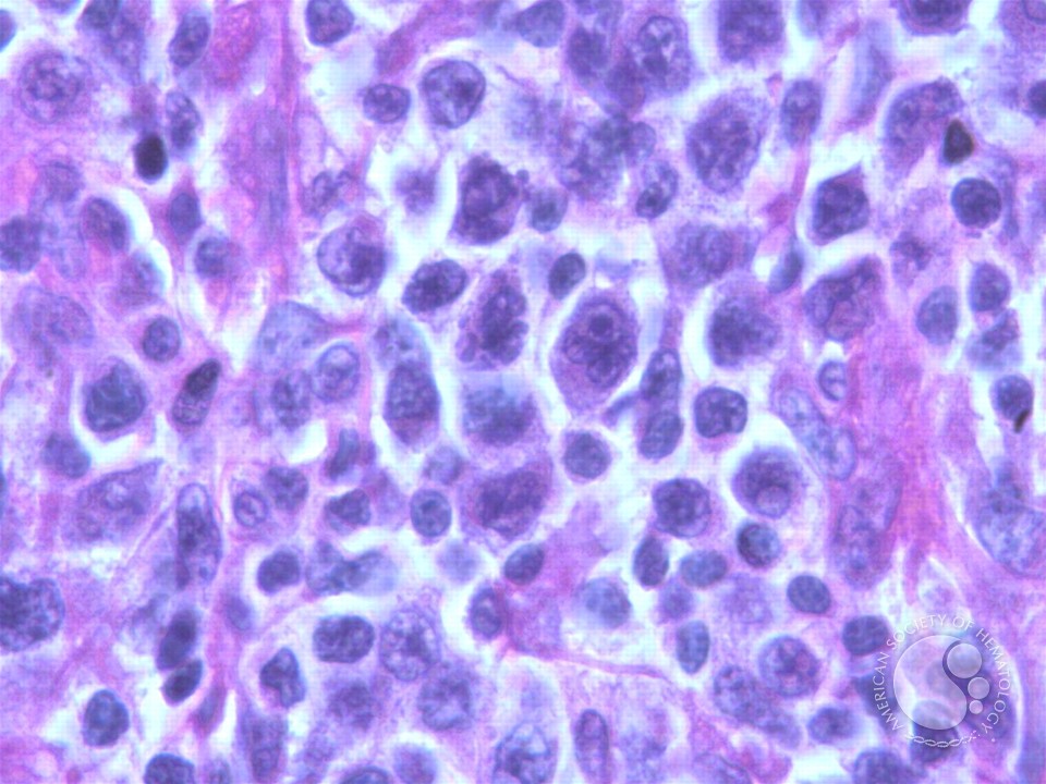 Peripheral T Cell Lymphoma, NOS - 3.