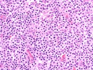 Peripheral T Cell Lymphoma, NOS - 4.