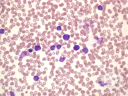 Ph+ Acute Lymphoblastic Leukemia - 1.