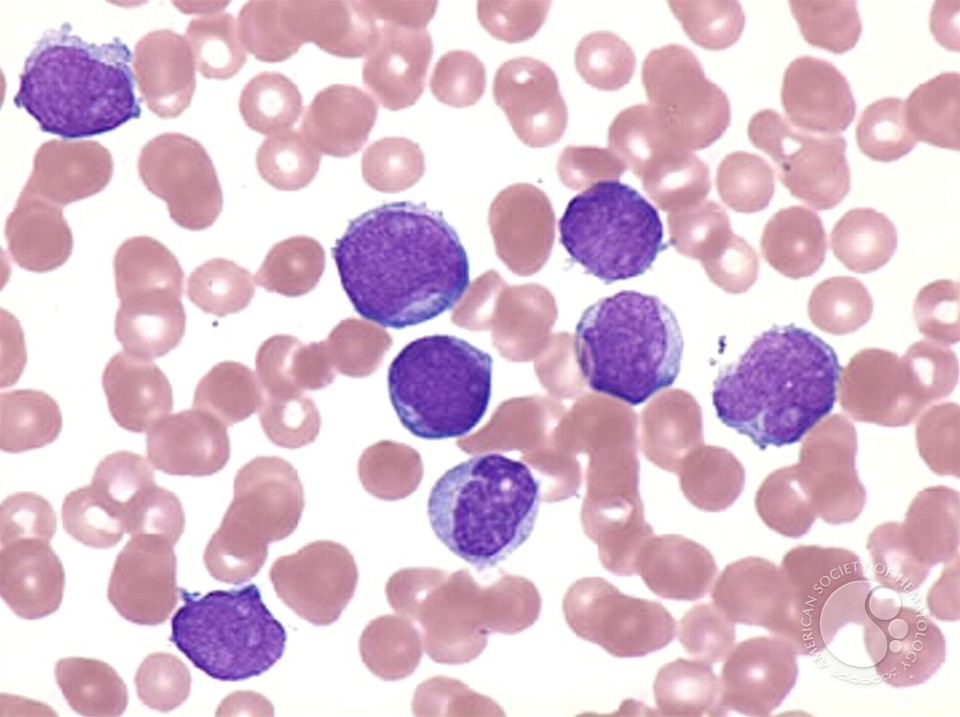 Ph+ Acute Lymphoblastic Leukemia - 2.