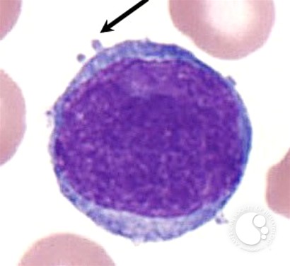 Ph+ Acute Lymphoblastic Leukemia - 4.