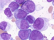 Acute Myeloid Leukemia With Maturation 7 5455