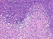 Tularemia Lymphadenitis - 3.