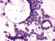 Precursor T-cell Acute Lymphoblastic Leukemia - 1.