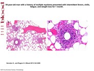 Multiple “doughnut” granulomas in Coxiella burnetii infection (Q fever)