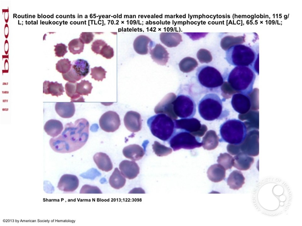 Pancytopenia following vivax malaria in a CLL patient