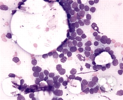 Precursor T-cell Acute Lymphoblastic Leukemia - 1.