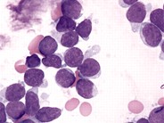 Precursor Tcell Acute Lymphoblastic Leukemia 2.