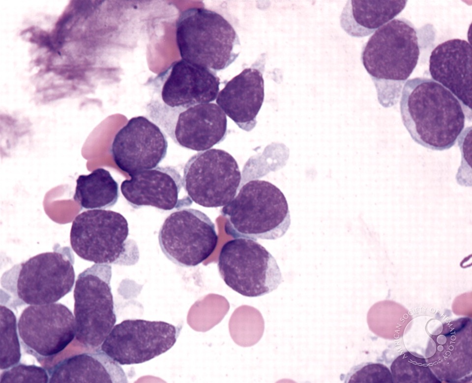 Precursor T-cell Acute Lymphoblastic Leukemia - 2.