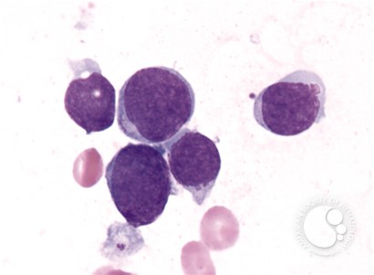 Precursor T-cell Acute Lymphoblastic Leukemia - 3.