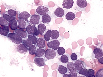 Precursor T-cell Acute Lymphoblastic Leukemia - 4.