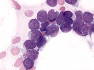 Precursor Tcell Acute Lymphoblastic Leukemia 5.