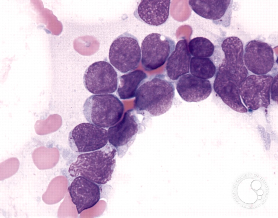 Precursor T-cell Acute Lymphoblastic Leukemia - 5.