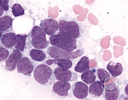 Precursor T-cell Acute Lymphoblastic Leukemia - 6.
