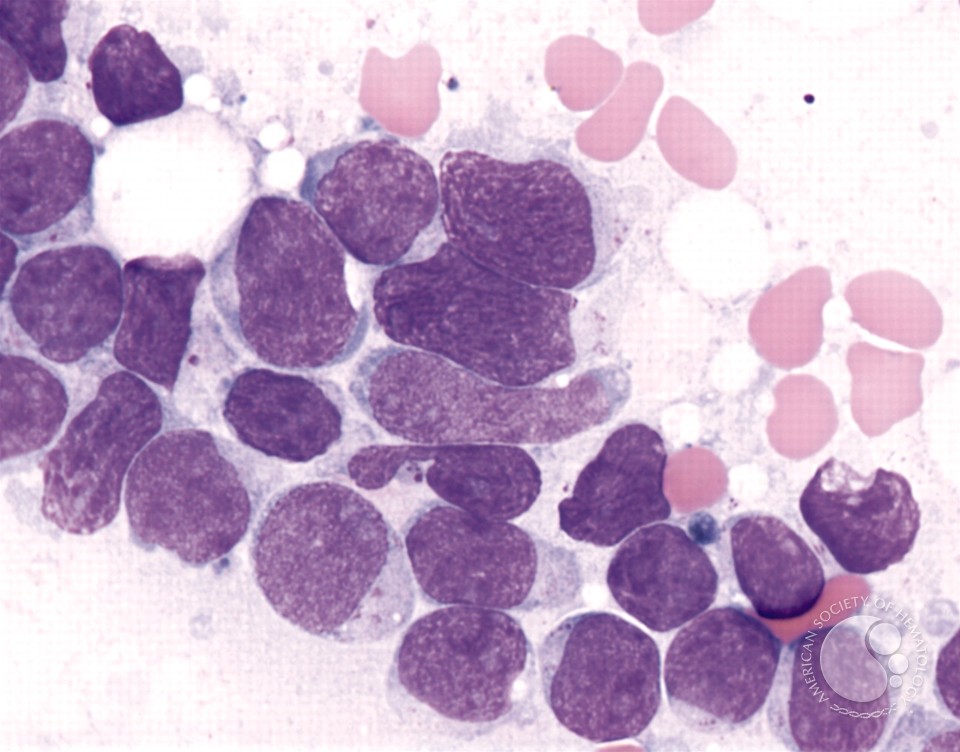 Precursor T-cell Acute Lymphoblastic Leukemia - 6.