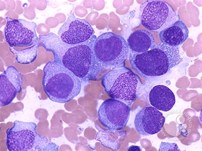 Acute Monocytic Leukemia - 1.