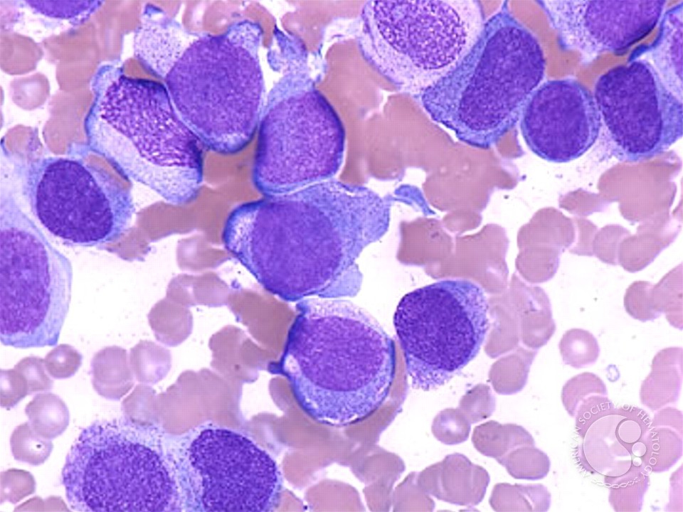 Acute Monocytic Leukemia - 2.
