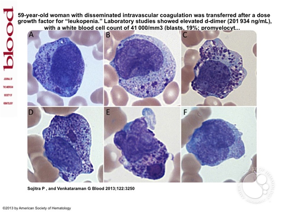 Chediak-Higashi–like granules within leukemic promyelocytes