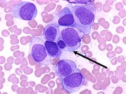 aml-m5-acute-monoblastic-leukaemia-learnhaem-haematology-made-simple