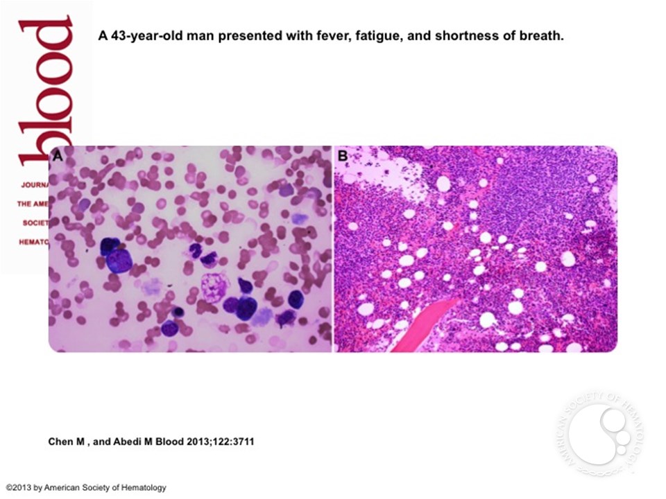 Atypical lymphocytosis, cold agglutinin hemolytic anemia, and monoclonal gammopathy in an HIV patient with marrow involvement by diffuse large B-cell lymphoma