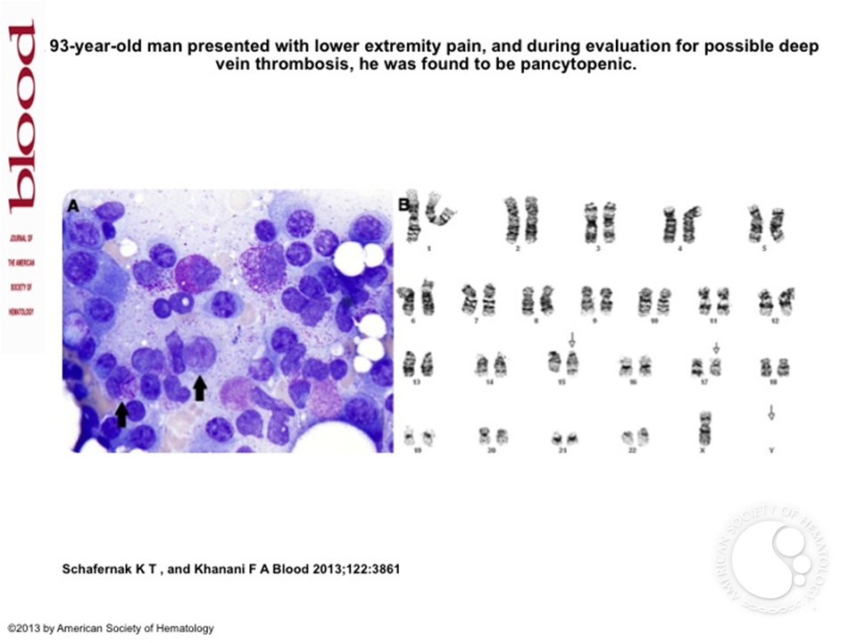 Simultaneous presentation of plasma cell myeloma and acute promyelocytic leukemia