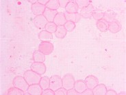 Kleihauer-Betke Hemoglobin F Acid Resistance - 4.